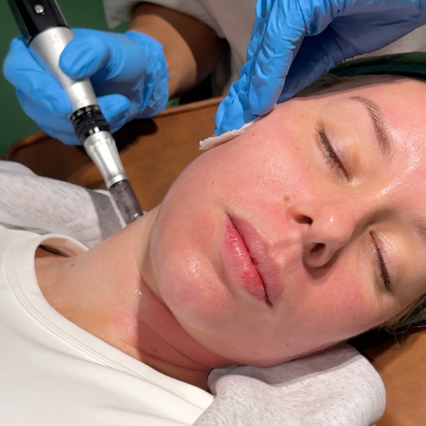 First-Time Skin Needling with Consultation & LED - Online Exclusive