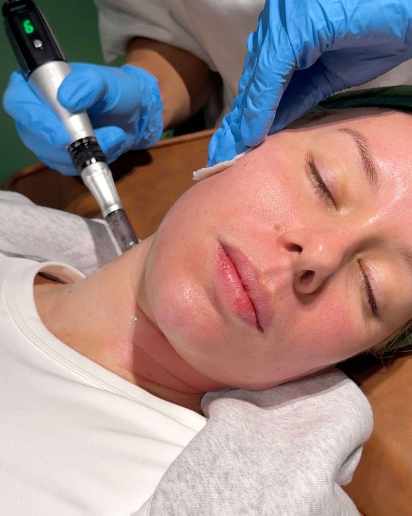 Skin Needling x 3 Pack