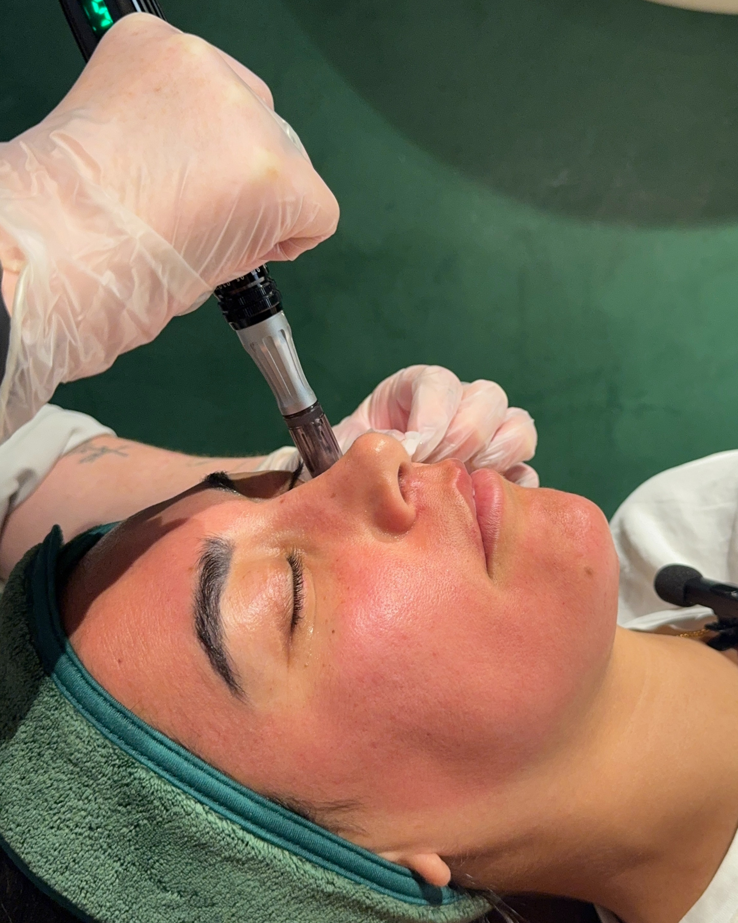 Skin Needling with Exosomes