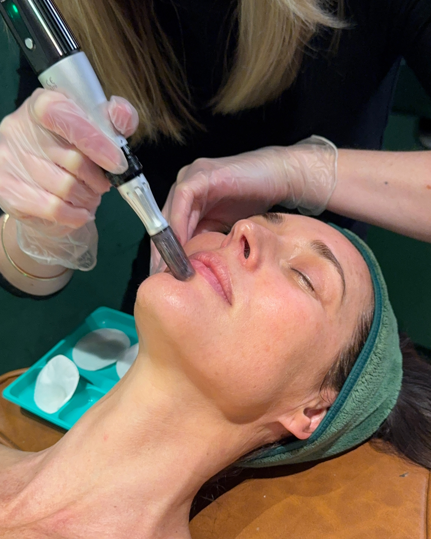 Skin Needling with Exosomes