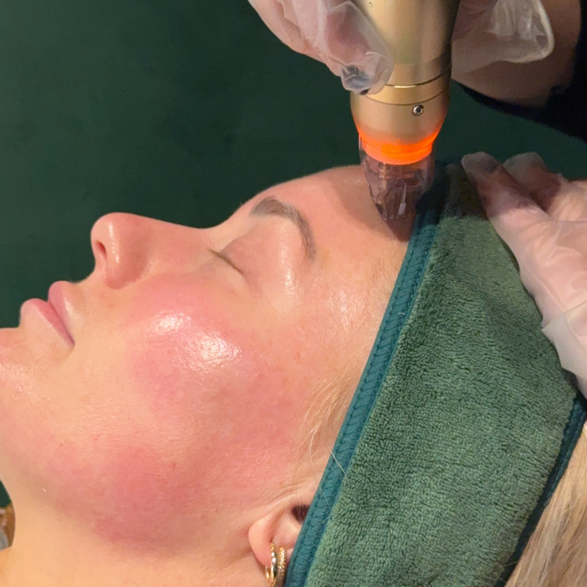 First-Time RF Needling with Consultation & LED - Online Exclusive