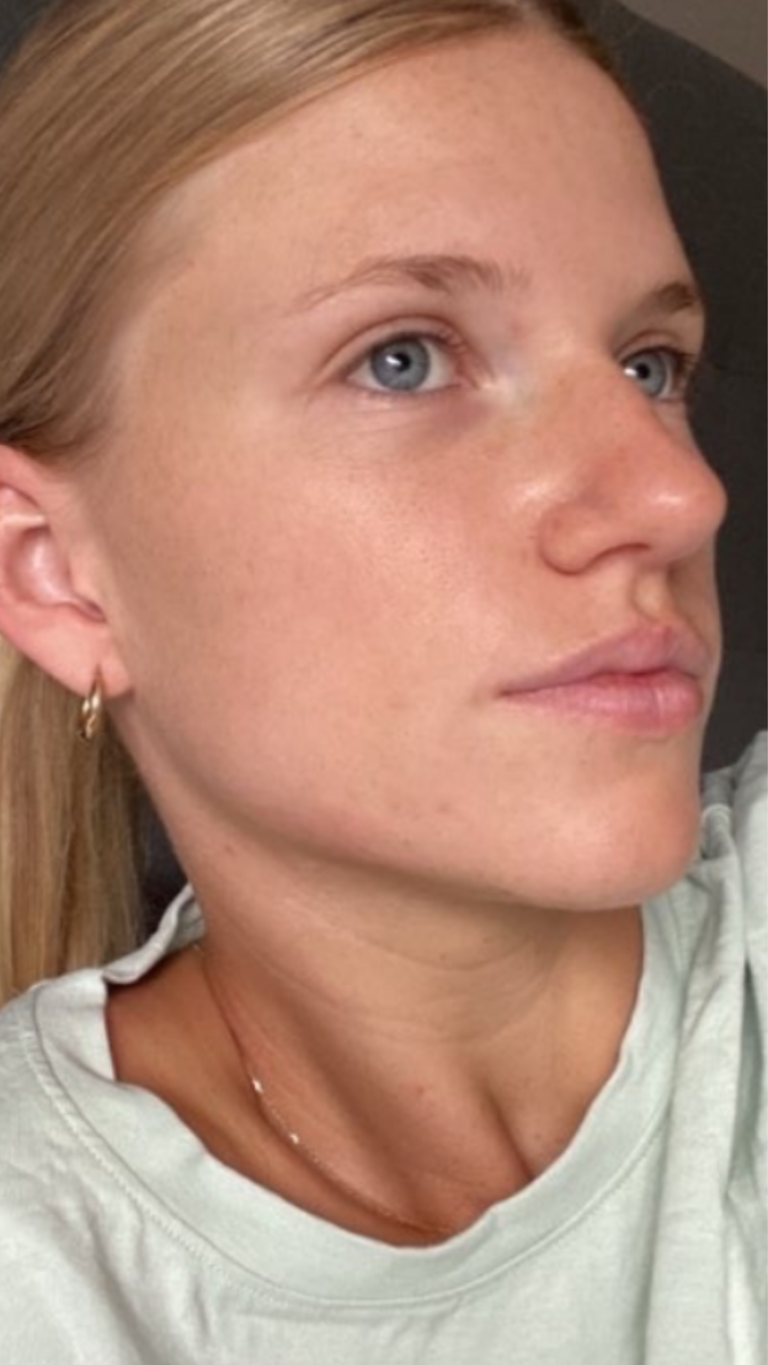 New Client | Skin Needling + Skin Consultation + LED | Online