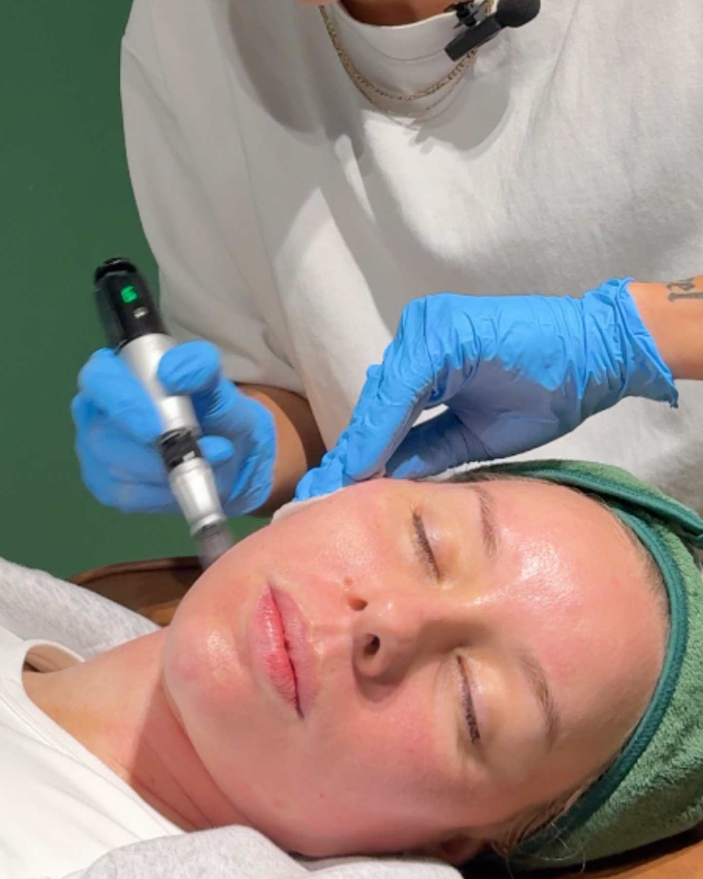 Winter New Client Skin Needling Promotion