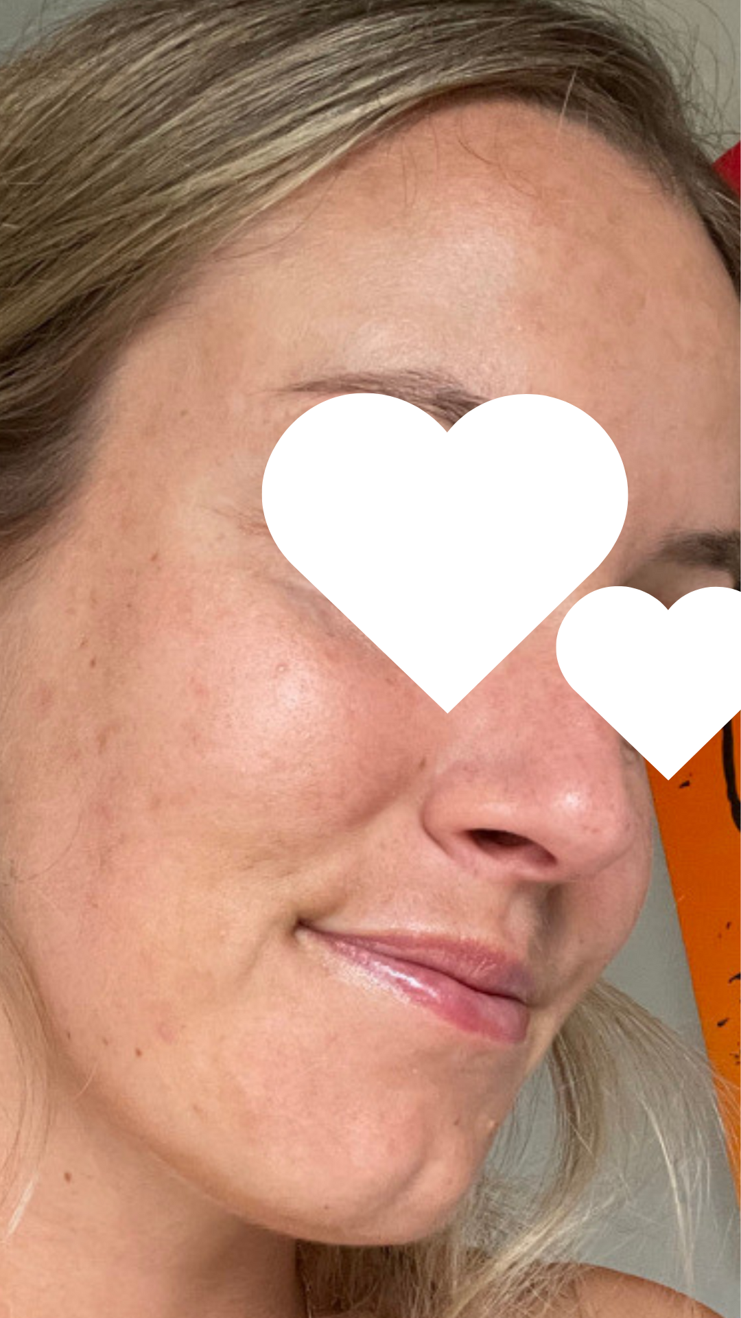 New Client | Skin Needling + Skin Consultation + LED | Online