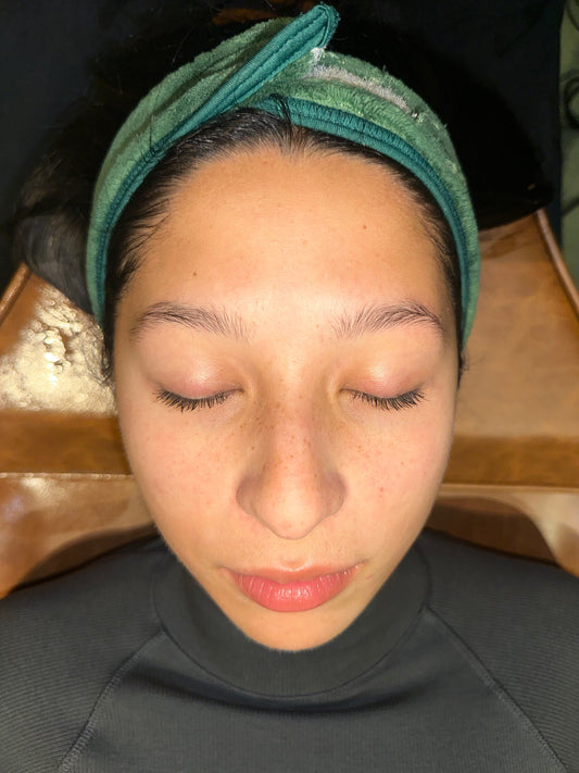 Combination Skin Needling & Herbal B Peel x 6 Series