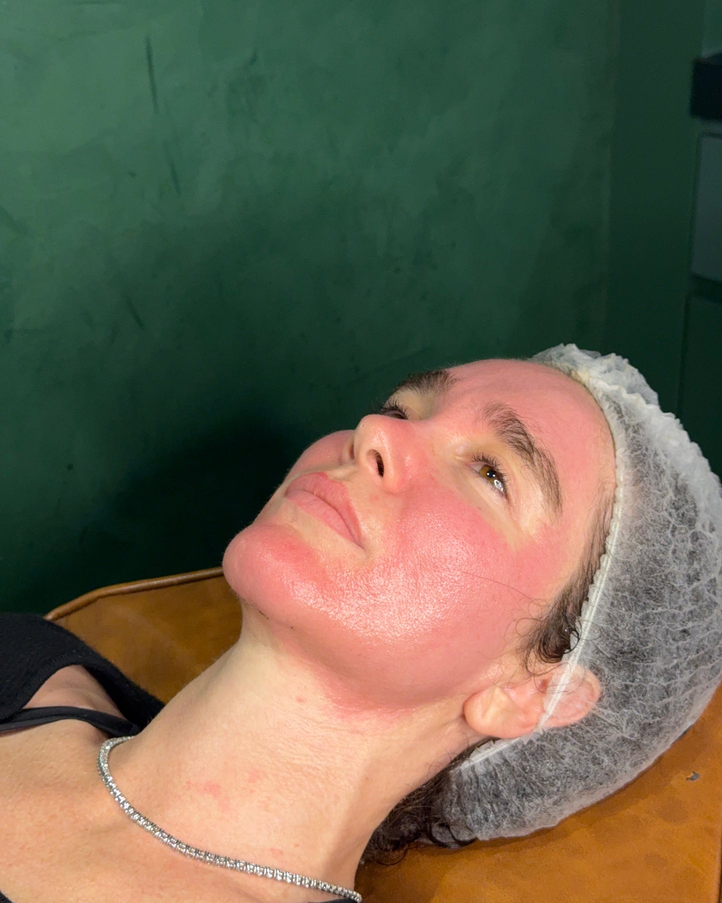K-Beauty Spicule Treatment