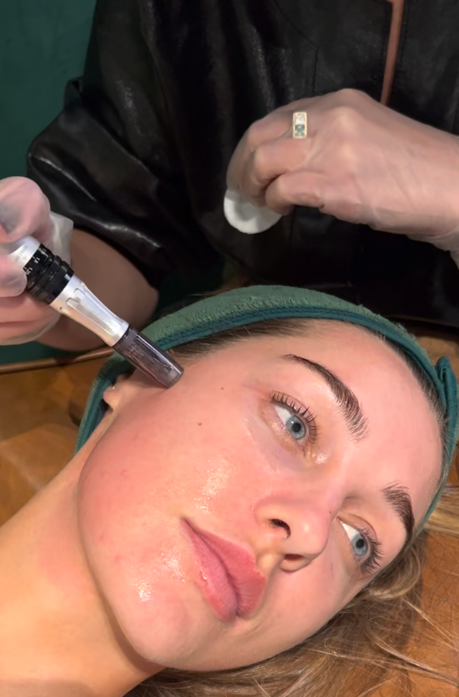 Skin Needling