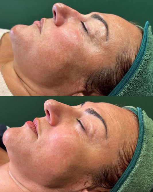 How does Skin Needling help Uneven Skin Tone and Pigmentation?