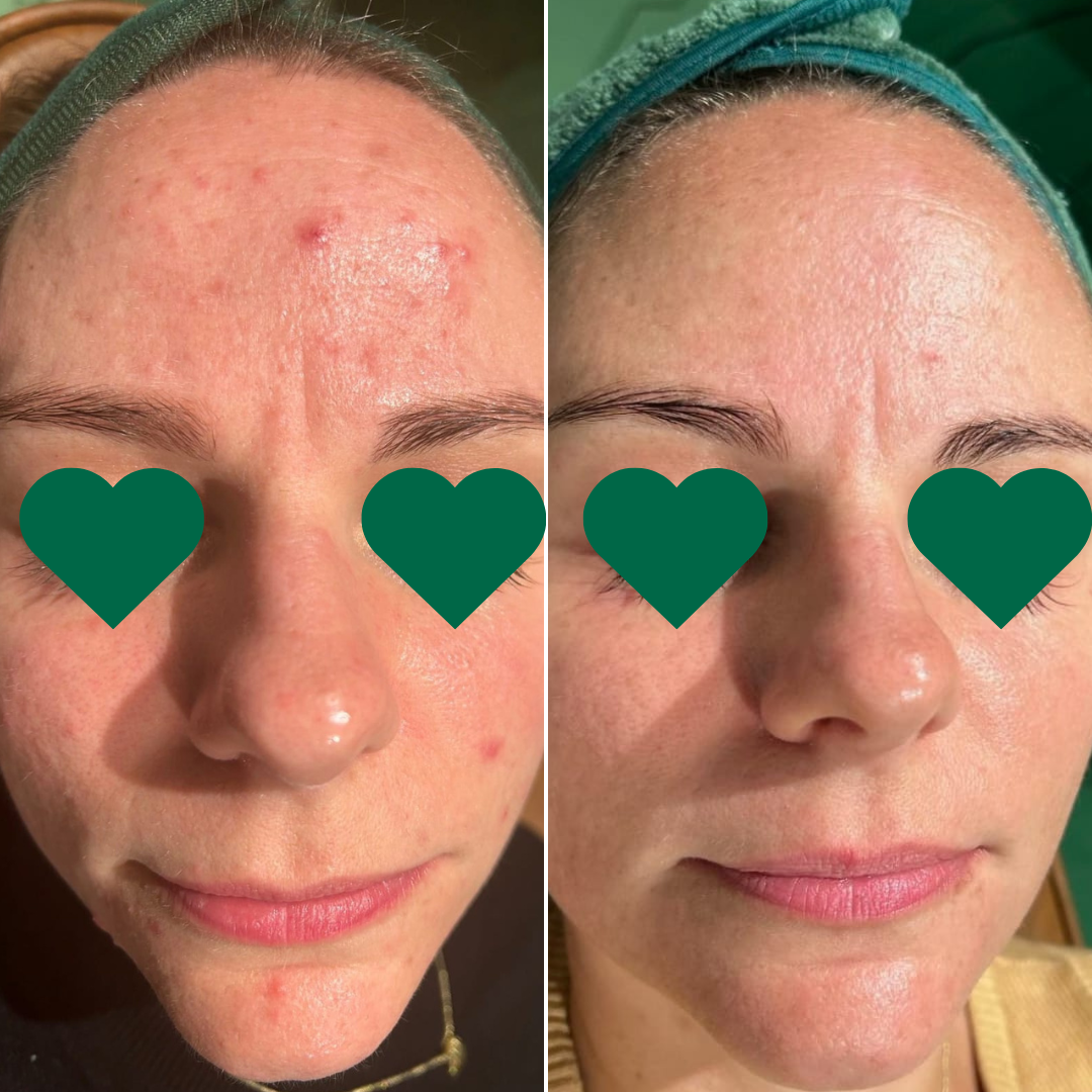 Skin Needling for Blackheads
