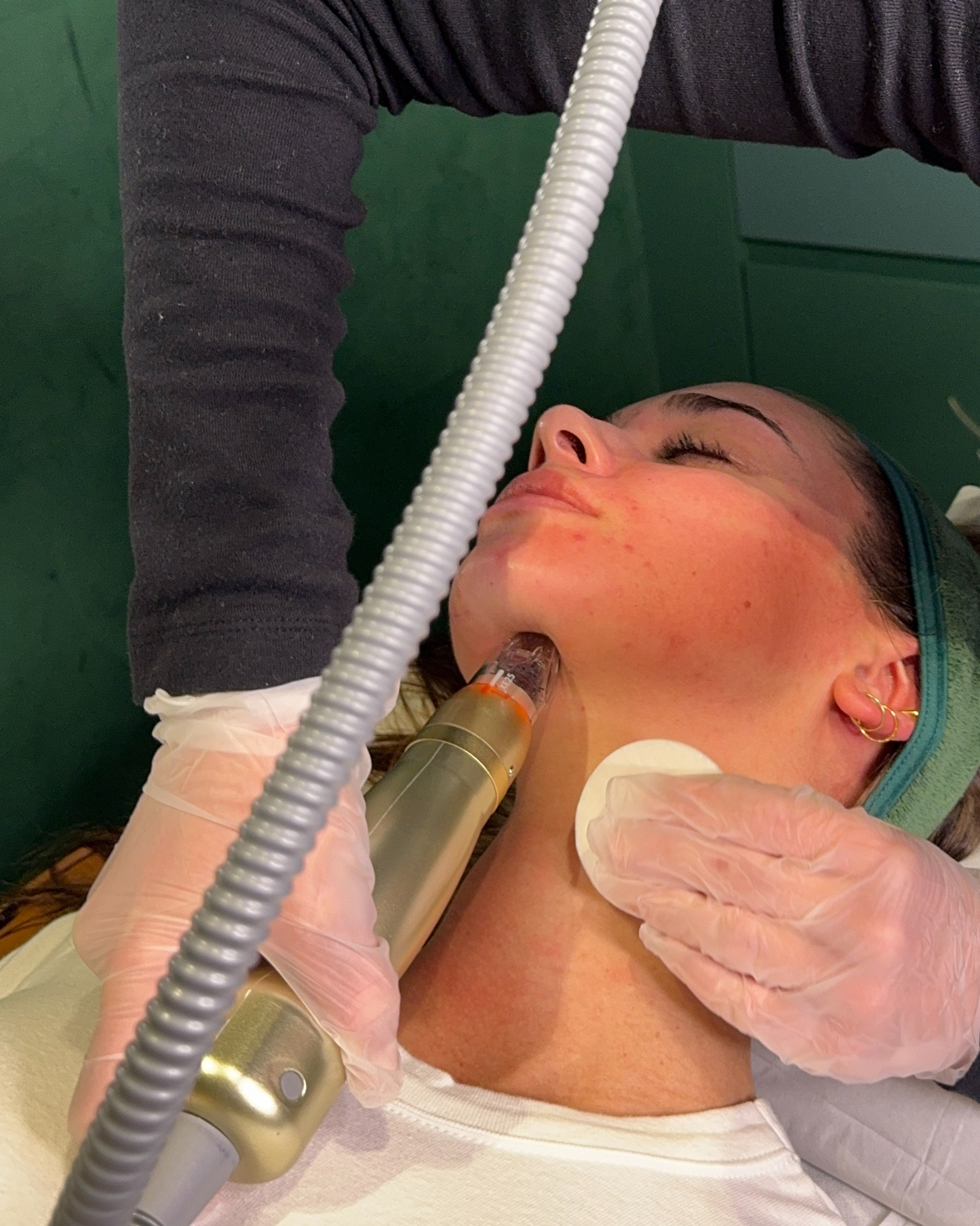 RF Needling x 6 Pack