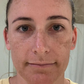 Cosmelan Peel