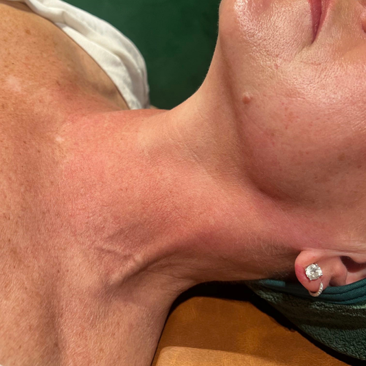 Skin Needling & RF Needling add-ons