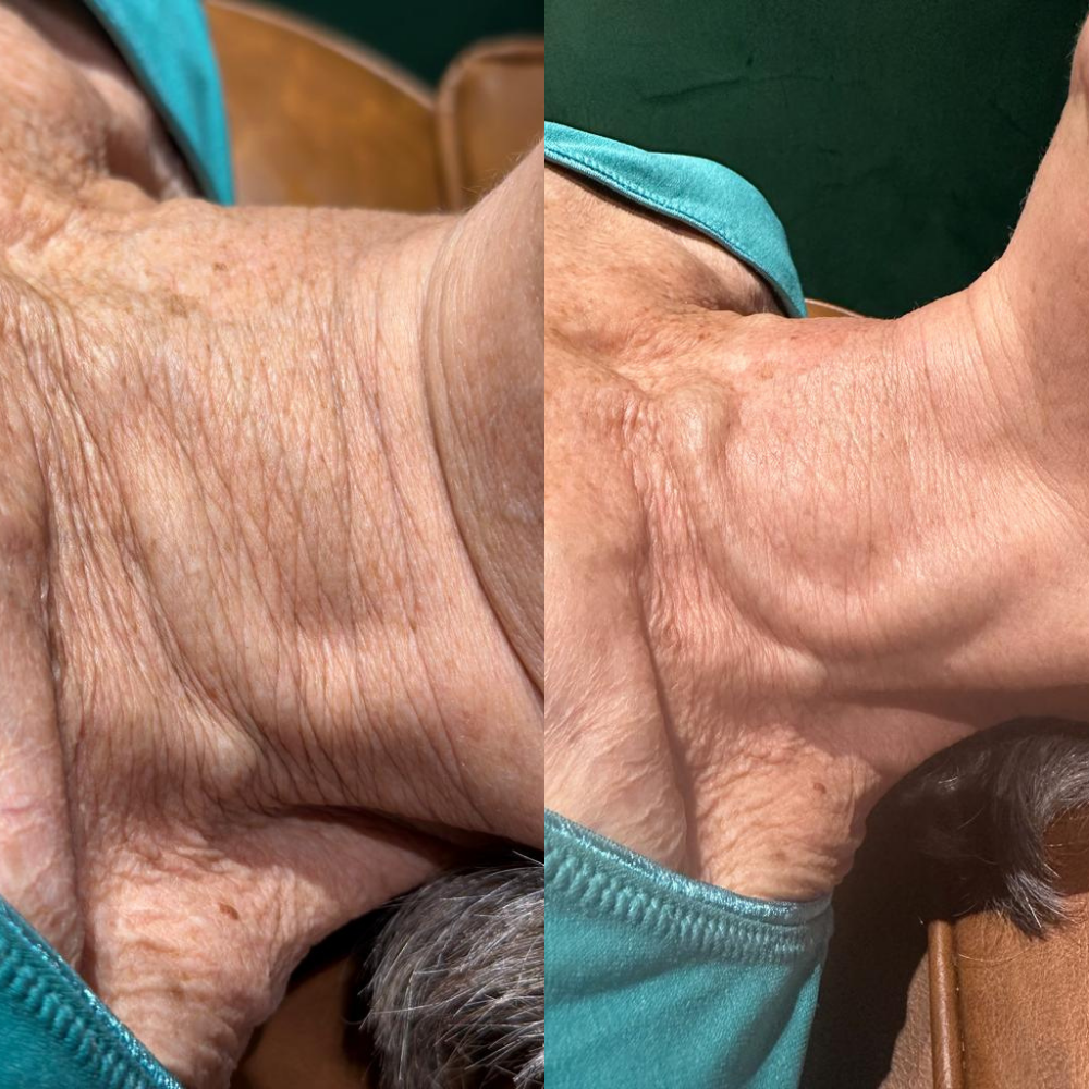 Skin Needling & RF Needling add-ons