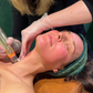RF Needling