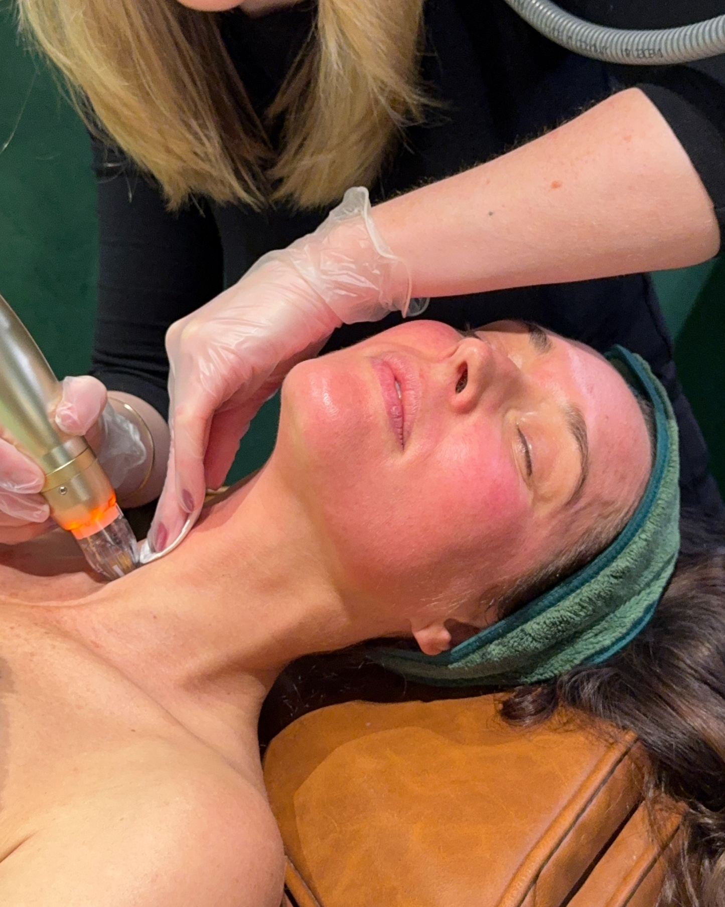 RF Needling