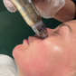 RF Needling