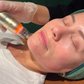 RF Needling x 6 Pack