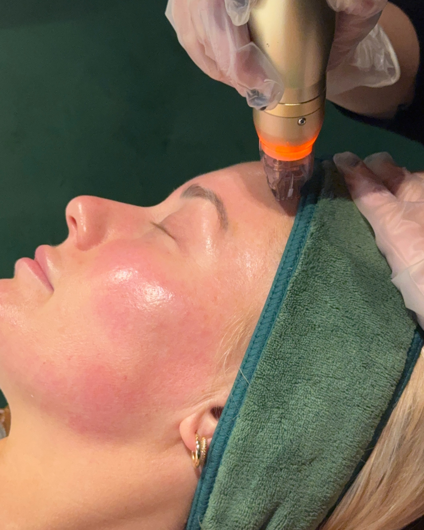 RF Needling