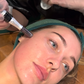 Winter New Client Skin Needling Promotion