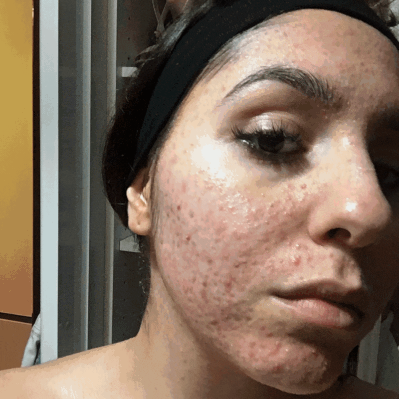 Skin Rippling Gif New Client | Skin Needling + Skin Consultation +LED – The Skin Bar Store