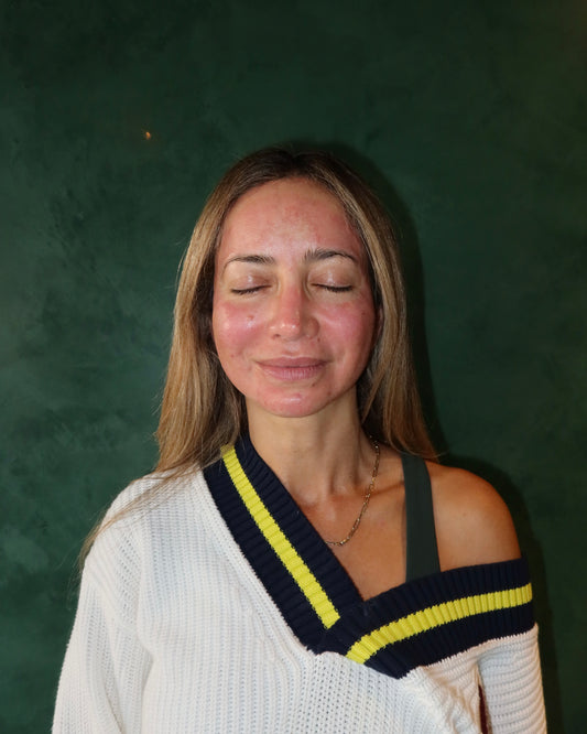 Winter New Client Skin Needling Promotion
