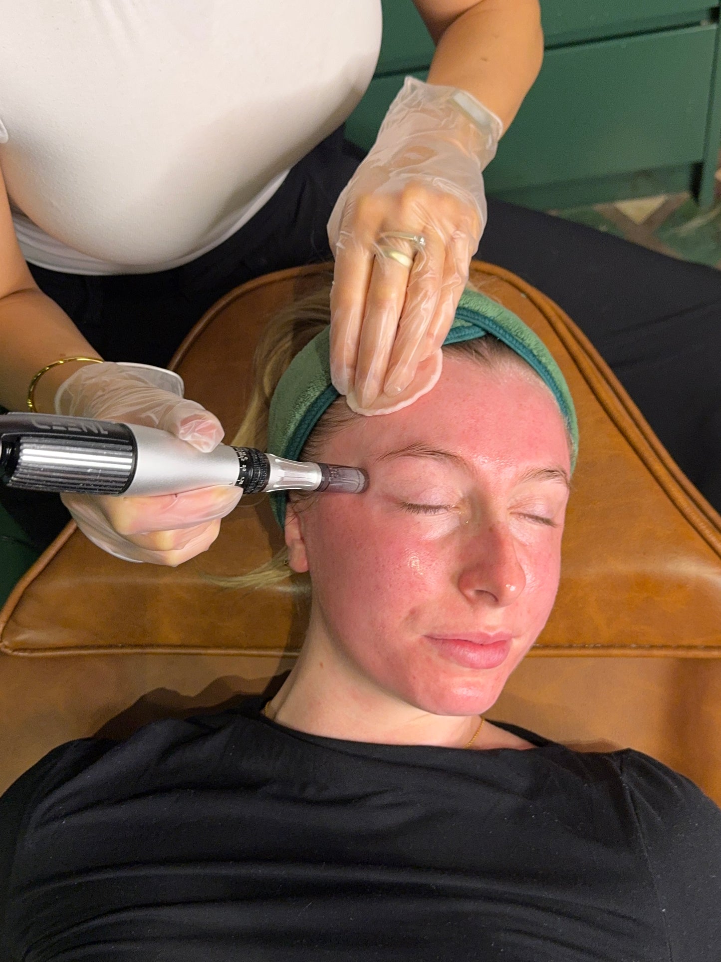 Skin Needling x 6 Series