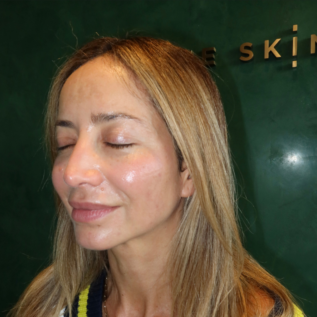 Skin Needling x 3 Series