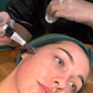 Skin Needling