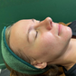 RF Needling