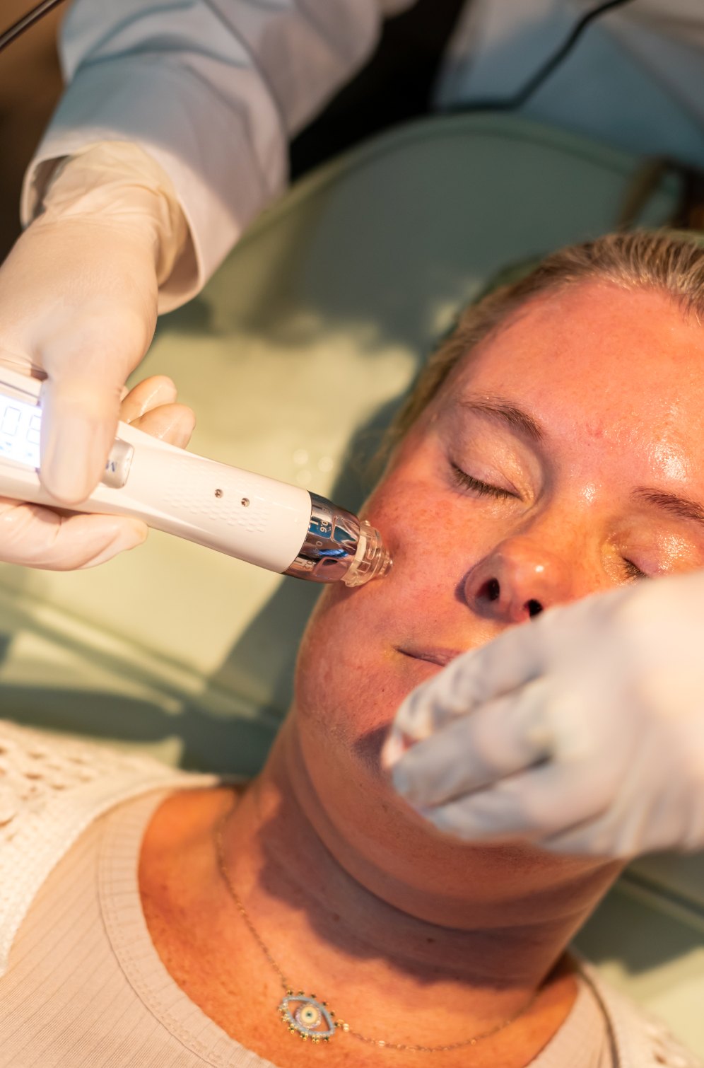 New Client | Skin Needling + Skin Consultation + LED | Narrabeen