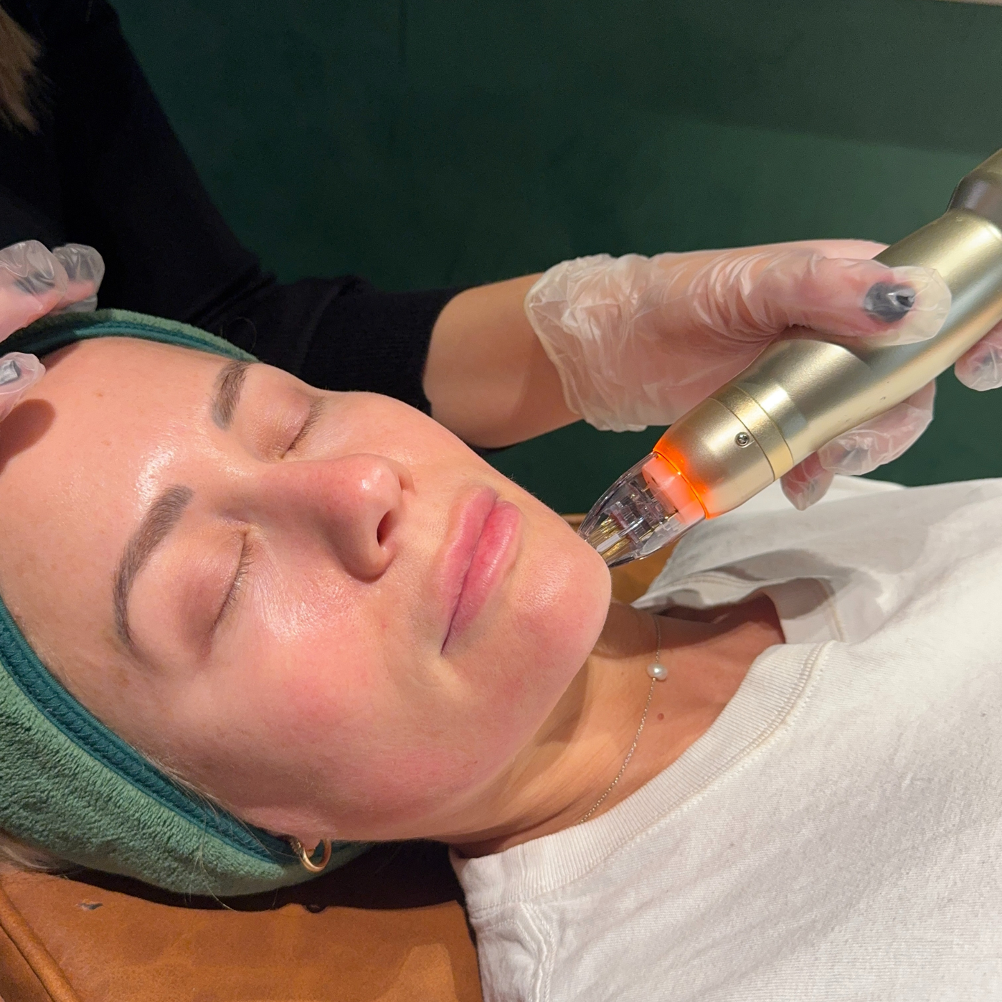 First-Time RF Needling with Consultation & LED