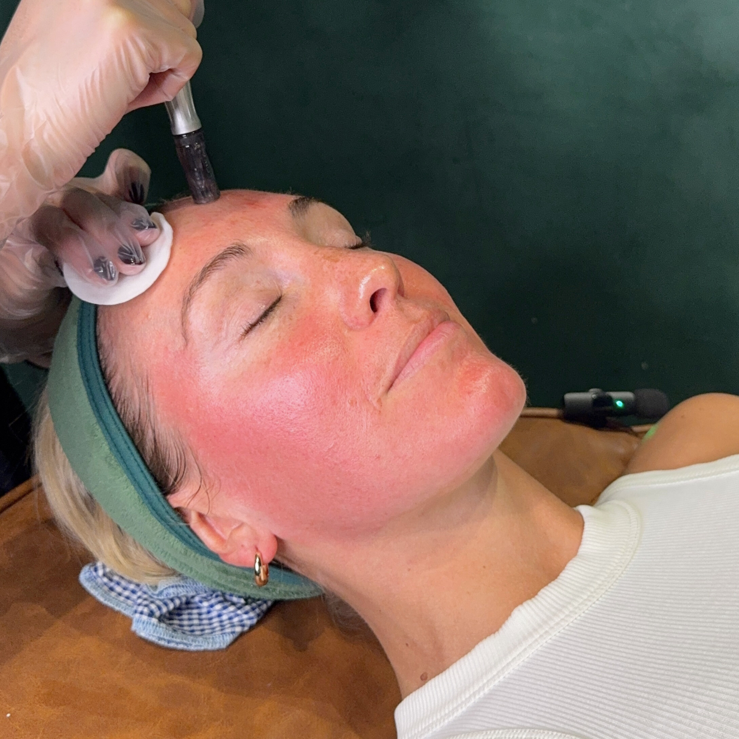 Skin Needling x 3 Series